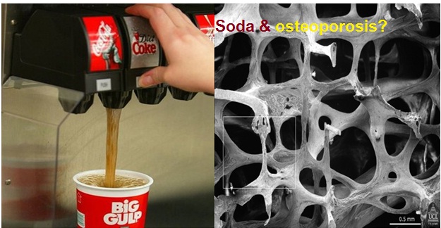 Soda and osteoporosis linked