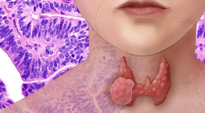 JANUARY IS THYROID AWARENESS MONTH