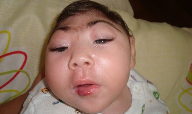 Virus Causing Babies to Have Small Heads Making Way to US; Countries Say Don’t Get Pregnant