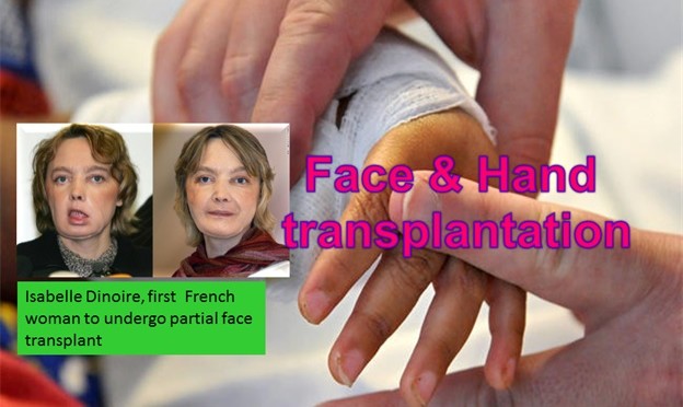 Face and Hand Transplantation