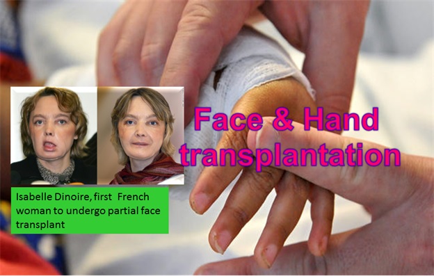 Face and Hand Transplantation