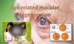 Age Related Macular Degenration