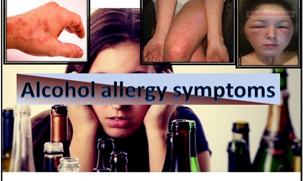 Alcohol Allergy Symptoms