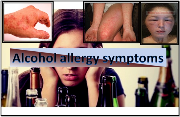 Alcohol Allergy Symptoms