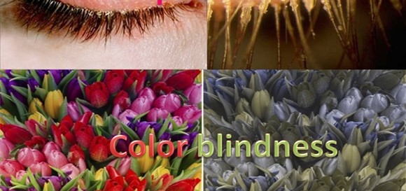 Blepharitis - Color Blindness