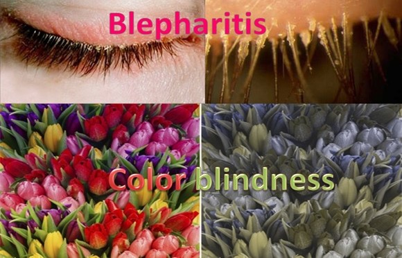 Blepharitis - Color Blindness