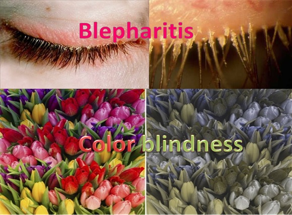 Blepharitis - Color Blindness