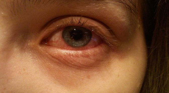 Conjunctivitis