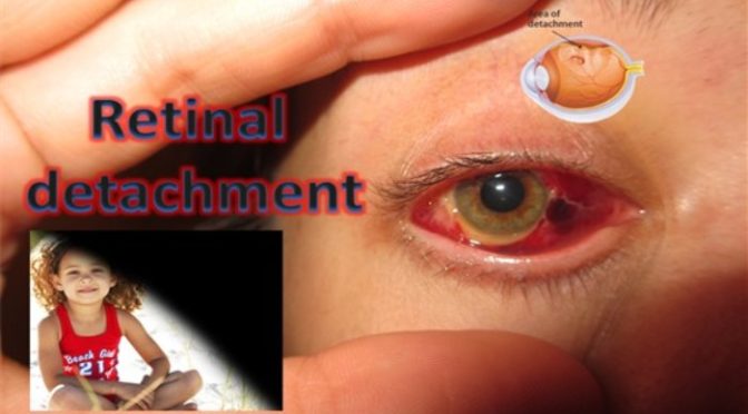 Retinal Detachment