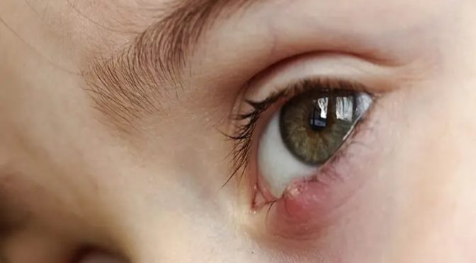 Stye - Eyelid Cyst