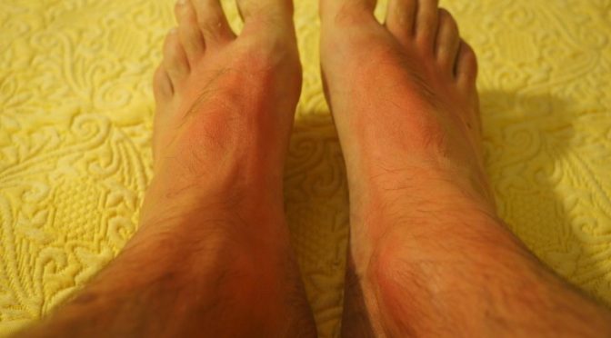 Skin Care Tips For Diabetic Patients