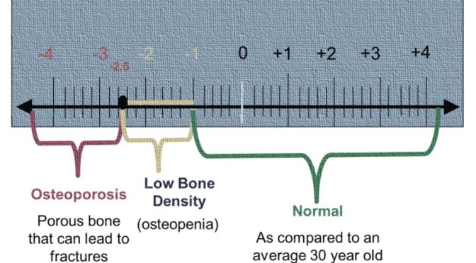 Bone Density Test