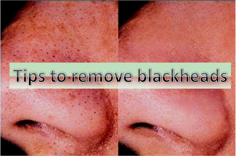 How to remove blackheads?
