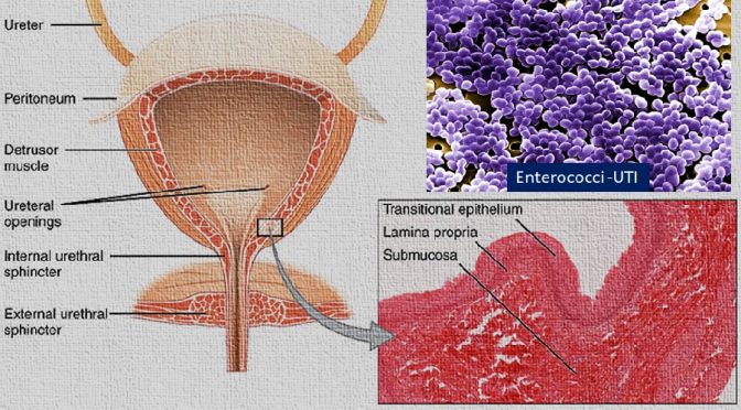 Common causes and remedies for Urinary Tract Infection