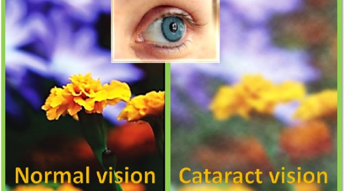 Cataract Vision