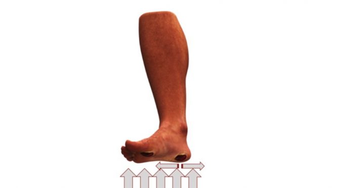 Diabetic foot care tips