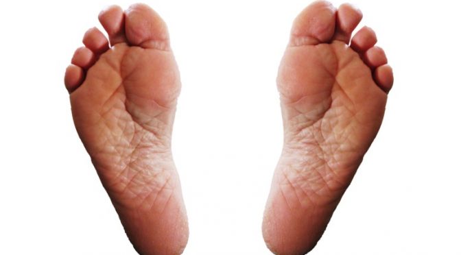 Cracked heels – what is the solution?