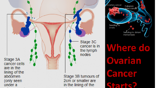 Ovarian cancer originates from Fallopian tubes!