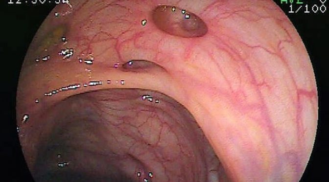 Inflammatory bowel disease