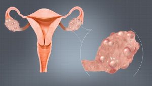 PCOS symptoms and diet