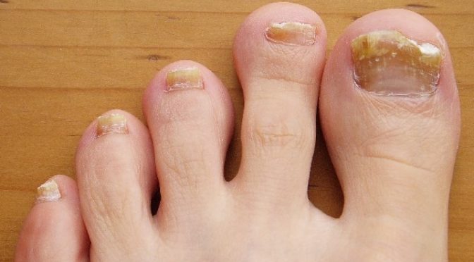 Toenail infection
