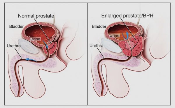 Prostate health tips
