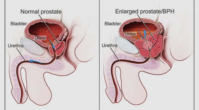 Prostate health tips
