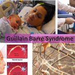 Guillain Barre Syndrome