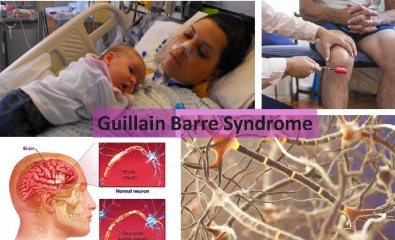 Guillain Barre Syndrome - HealthyLife | WeRIndia