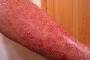 Food choice for psoriasis