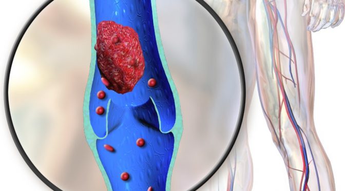 Deep Vein Thrombosis
