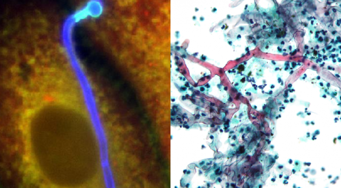 What are the types of mucormycosis infections?