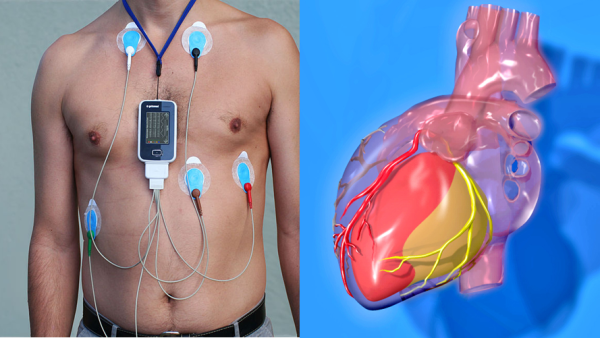 Ambulatory Rhythm Monitoring Tests And Coronary Angiogram