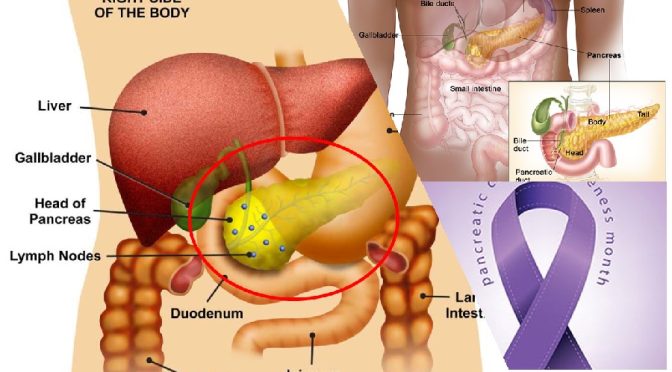 Pancreatic cancer awareness