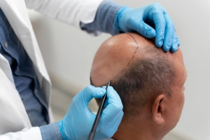 After a hair transplant, what can you do?