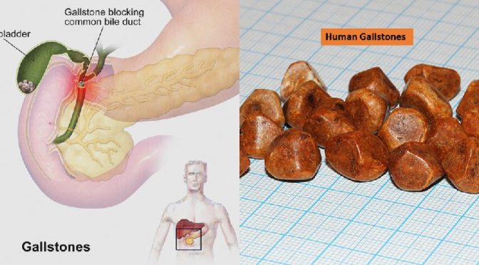 Gallstone prevention tips