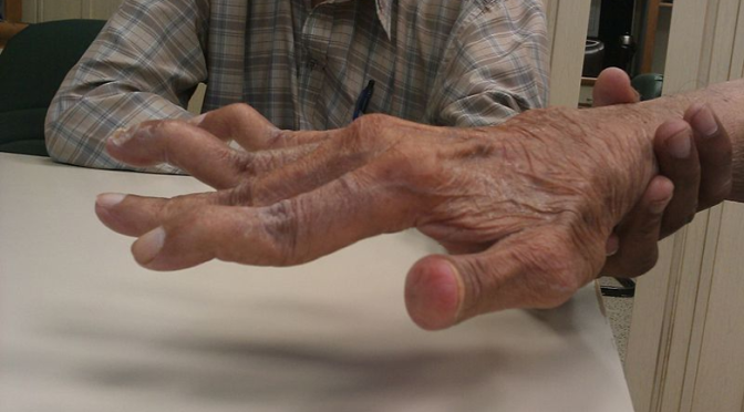 What Happens In Rheumatoid Arthritis?