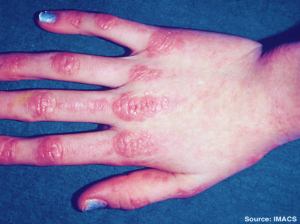 Common symptoms of Myositis