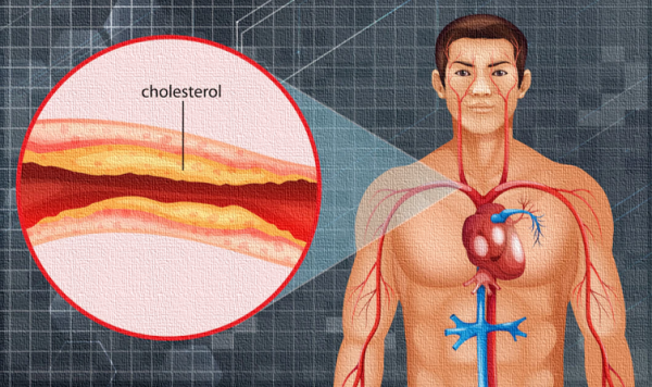 High cholesterol Bad cholesterol
