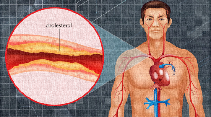 High cholesterol Bad cholesterol