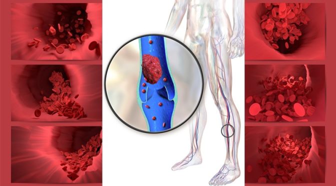 Blood clot prevention