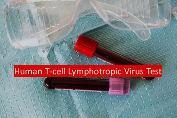 HTLV -Human T-cell Lymphotropic Virus Presence Test