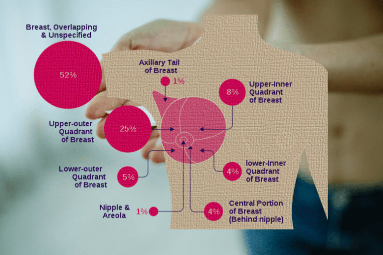 Understanding Breast Cancer Risk Factors And Prevention Strategy ...