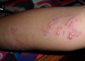 Herpes infection