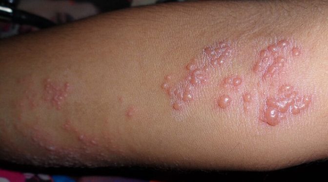 Herpes infection