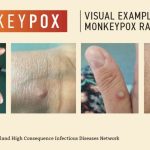 Monkey pox outbreak