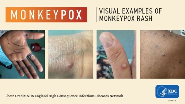 Monkey pox outbreak