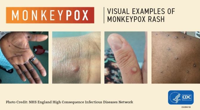 Monkey pox outbreak