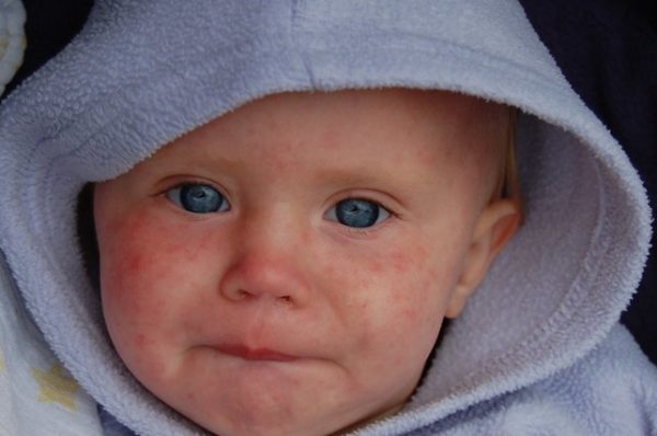 Measles in children