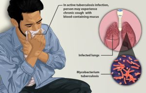 Tuberculosis outbreak in Kansas city